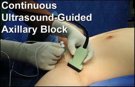 Clinical Topic: Learning Ultrasound Guided Regional Anesthesia